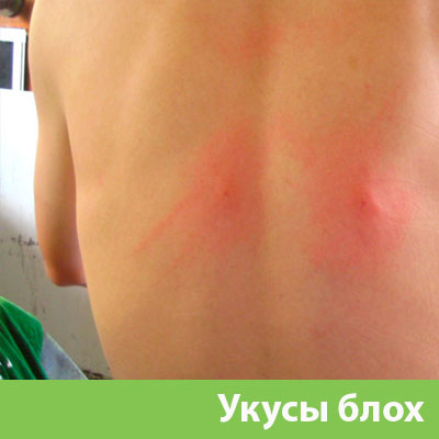 Укусы блох в Чехове