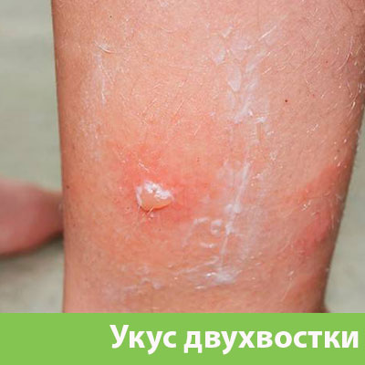 Укус двухвостки в Чехове