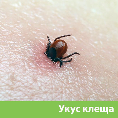 Укус клеща в Чехове