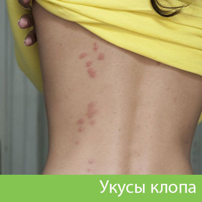 Профессиональное уничтожение клопов в Чехове